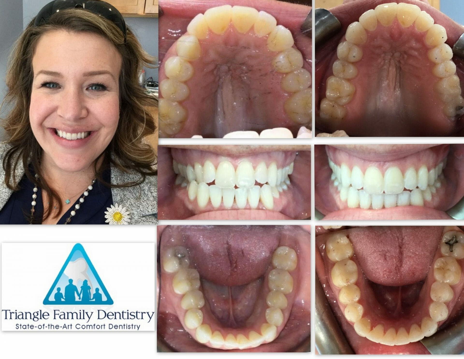 a-m-invisalign-dental-office-cosmetic-dentist-triangle-family-dentistry-scaled