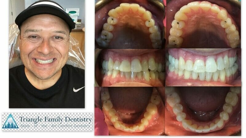 cosmetic-dentist-triangle-family-dentistry-cary-park-nc-apex-Feb2021