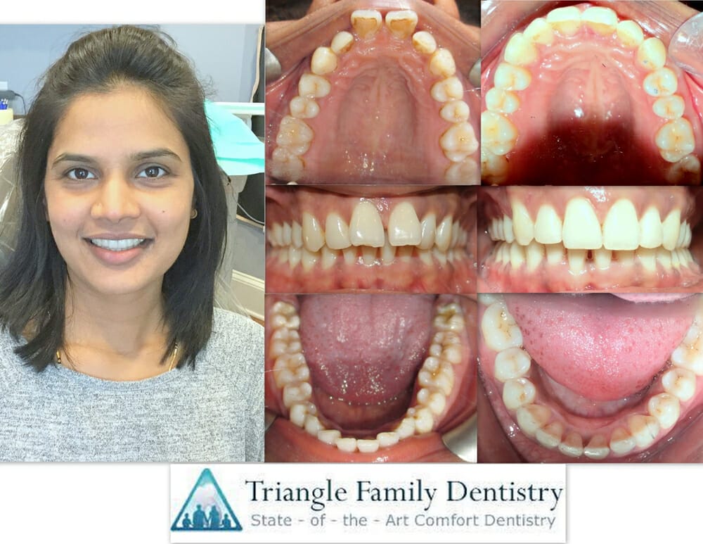 cosmetic-dentistry-triangle-family-dentist-Gregory