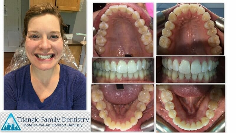 dentist-morrisville-nc-cosmetic-dentistry-triangle-family-dentistry-Feb2021