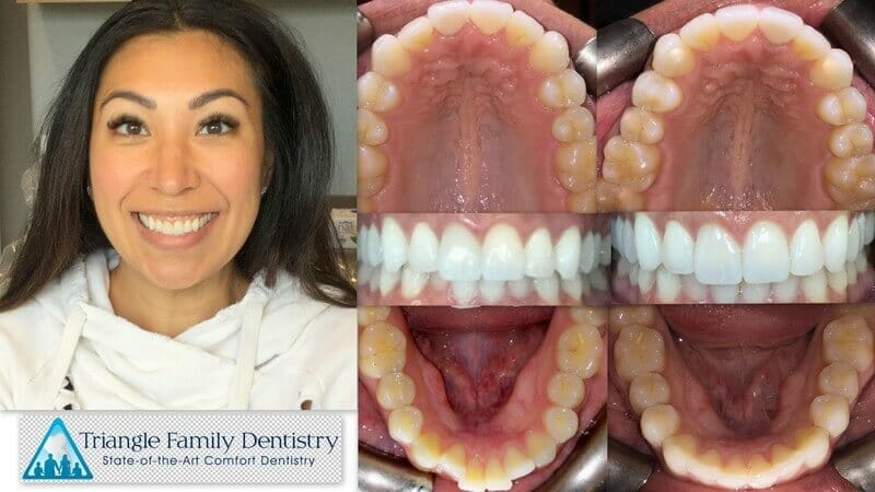 invisalign-cosmetic-dentist-wake-forest-nc-triangle-family-dentistry-Feb2021
