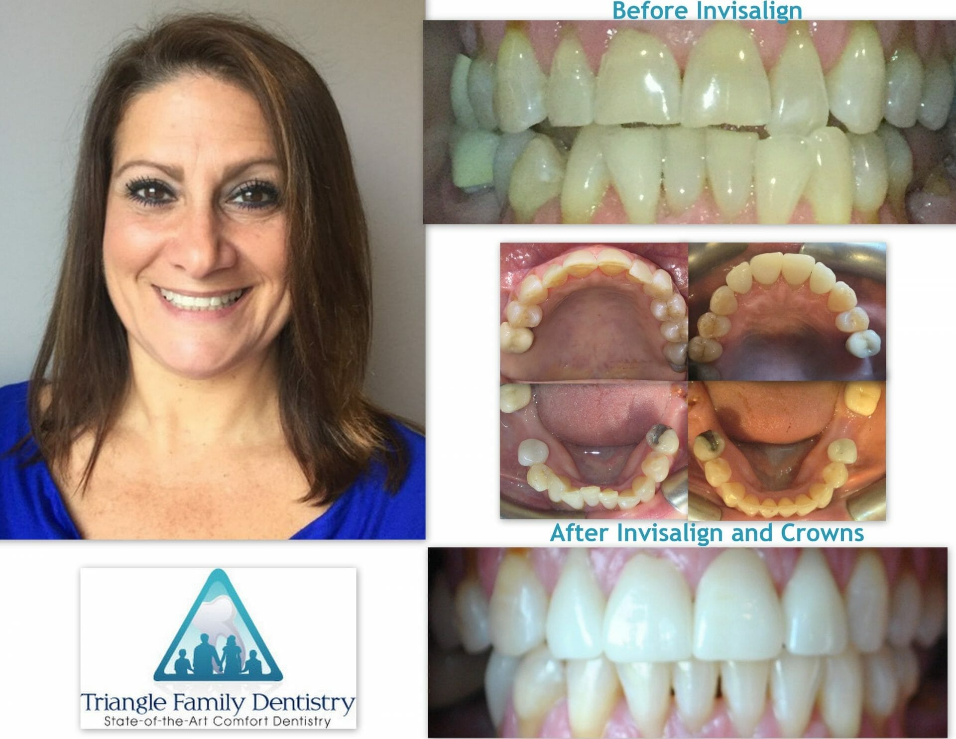 morrisville-dentist-invisalign-before-after-Sep2019