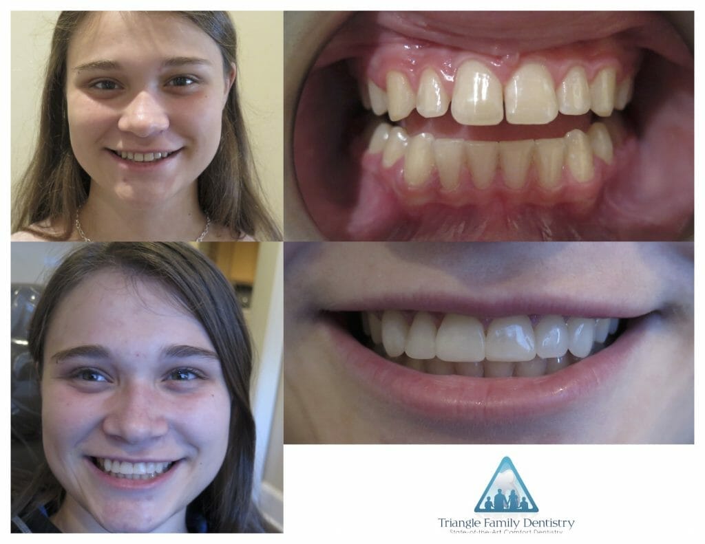 morrisville-dentist-invisalign-dental-veneers-Pt88