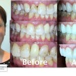 cosmetic dentistry - smile transformation - Triangle Family Dentistry