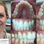 Invisalign - Cosmetic Dentist - Triangle Family Dentistry